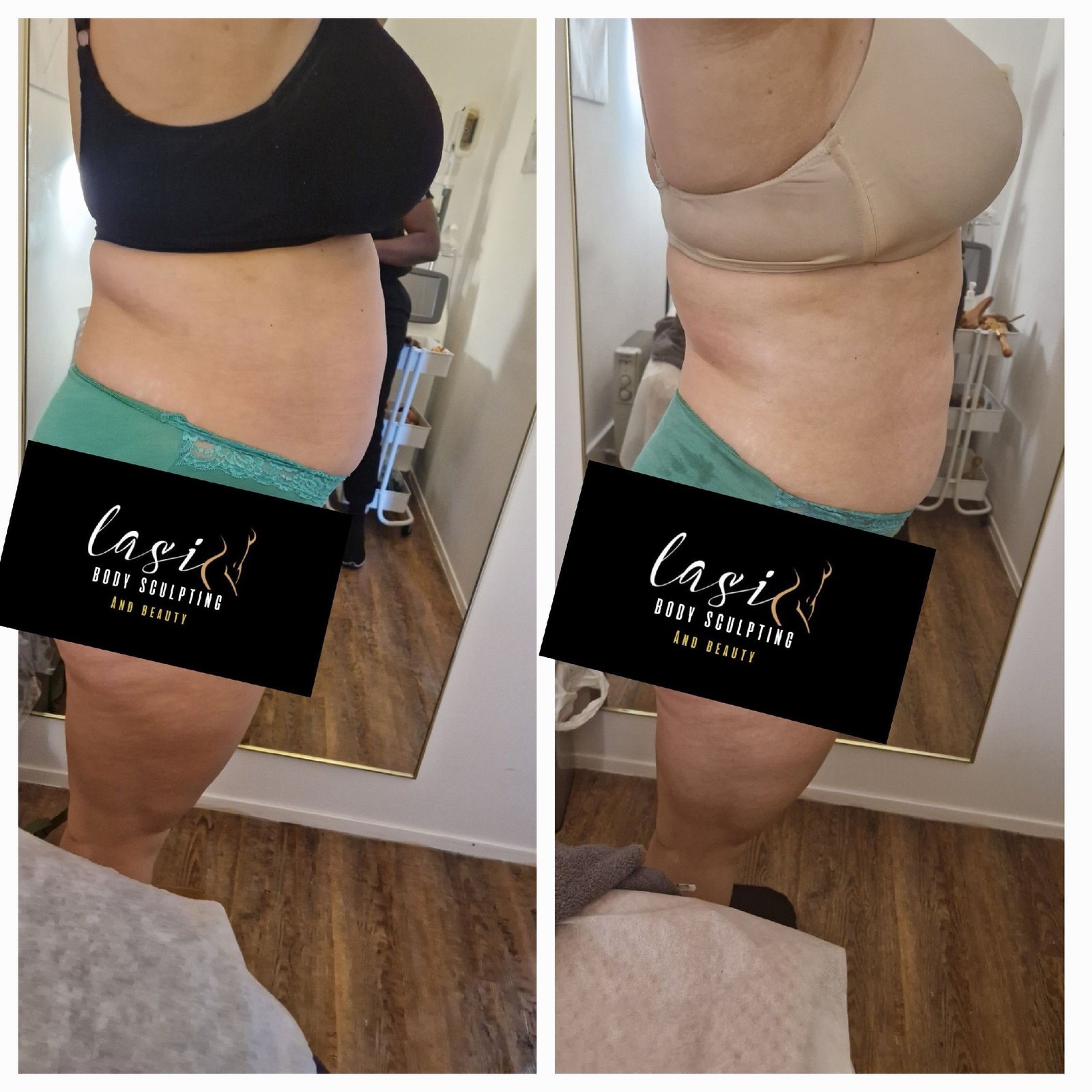 pre cellulite reduction treatment and post cellulite reduction treatment image